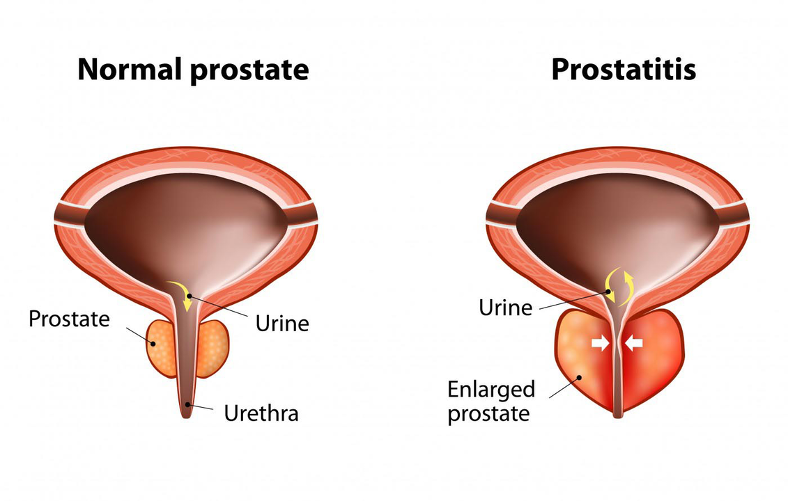 Prostat normal tina lalaki séhat sareng radang kelenjar prostat kalayan prostatitis