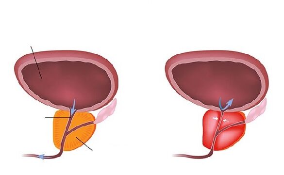 normal sareng racringing prostat